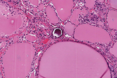 Classic variant papillary thyroid carcinoma
