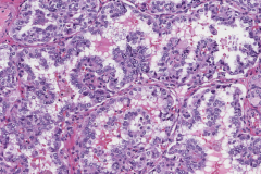 Classic variant papillary thyroid carcinoma