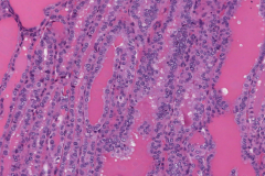 Classic variant papillary thyroid carcinoma