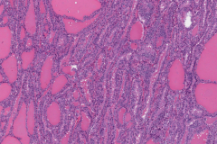 Classic variant papillary thyroid carcinoma