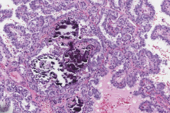 Classic variant papillary thyroid carcinoma