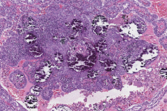 Classic variant papillary thyroid carcinoma