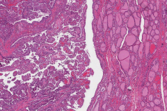 Classic variant papillary thyroid carcinoma