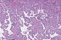 Classic variant papillary thyroid carcinoma