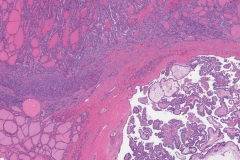 Classic variant papillary thyroid carcinoma