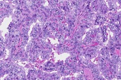 Classic variant papillary thyroid carcinoma