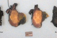 Classic variant papillary thyroid carcinoma