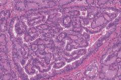Columnar variant papillary thyroid carcinoma