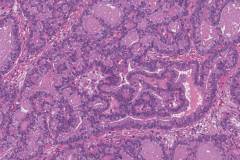 Columnar variant papillary thyroid carcinoma
