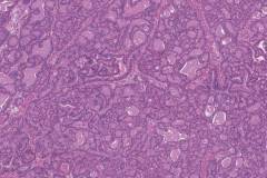Columnar variant papillary thyroid carcinoma
