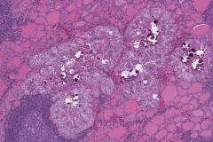 Classic variant papillary thyroid carcinoma