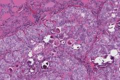 Classic variant papillary thyroid carcinoma