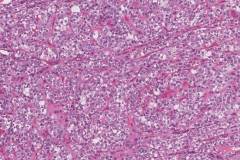 Solid variant papillary thyroid carcinoma