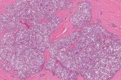 Solid variant papillary thyroid carcinoma