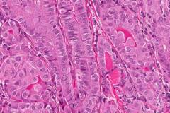 Tall cell variant papillary thyroid carcinoma