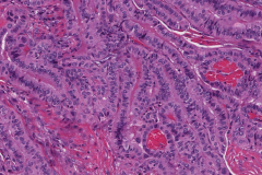 Tall cell variant papillary thyroid carcinoma