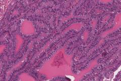 Tall cell variant papillary thyroid carcinoma