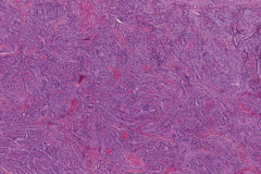 Tall cell variant papillary thyroid carcinoma