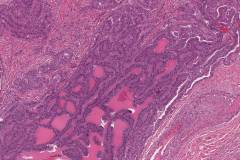 Tall cell variant papillary thyroid carcinoma