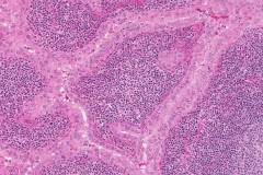 Warthin-like variant papillary thyroid carcinoma