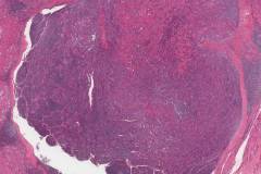 Warthin-like variant papillary thyroid carcinoma