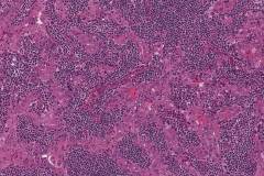Warthin-like variant papillary thyroid carcinoma