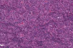 Classic variant papillary thyroid carcinoma