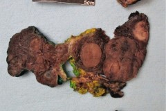 Papillary thyroid carcinoma and nodular follicular disease