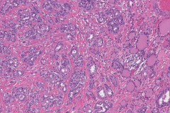 Classic variant papillary thyroid carcinoma arising from a thyroglossal duct cyst