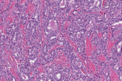 Classic variant papillary thyroid carcinoma arising from a thyroglossal duct cyst