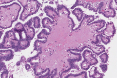 Classic variant papillary thyroid carcinoma arising from a thyroglossal duct cyst