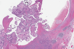 Classic variant papillary thyroid carcinoma arising from a thyroglossal duct cyst