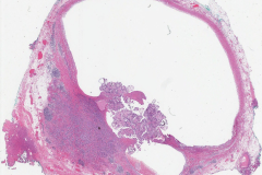 Classic variant papillary thyroid carcinoma arising from a thyroglossal duct cyst