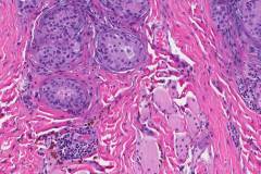 Classic variant papillary thyroid carcinoma