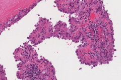 Hobnail variant papillary thyroid carcinoma