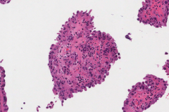 Hobnail variant papillary thyroid carcinoma
