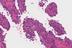 Hobnail variant papillary thyroid carcinoma