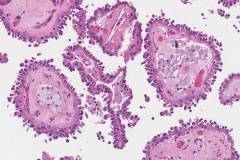 Hobnail variant papillary thyroid carcinoma