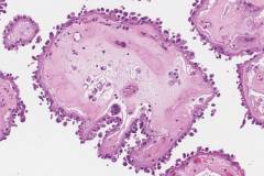 Hobnail variant papillary thyroid carcinoma