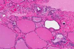 Classic variant papillary thyroid carcinoma
