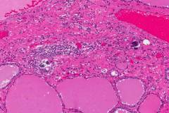 Classic variant papillary thyroid carcinoma