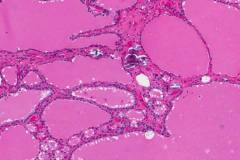 Classic variant papillary thyroid carcinoma