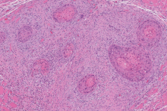 Tall cell variant papillary thyroid carcinoma with squamous differentiation