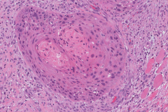 Tall cell variant papillary thyroid carcinoma with squamous differentiation