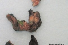 Tall cell variant papillary thyroid carcinoma