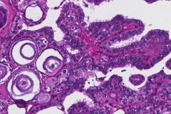 Classic variant papillary thyroid carcinoma