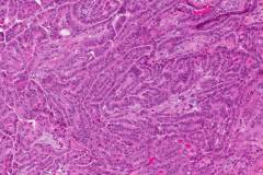 Tall cell variant papillary thyroid carcinoma