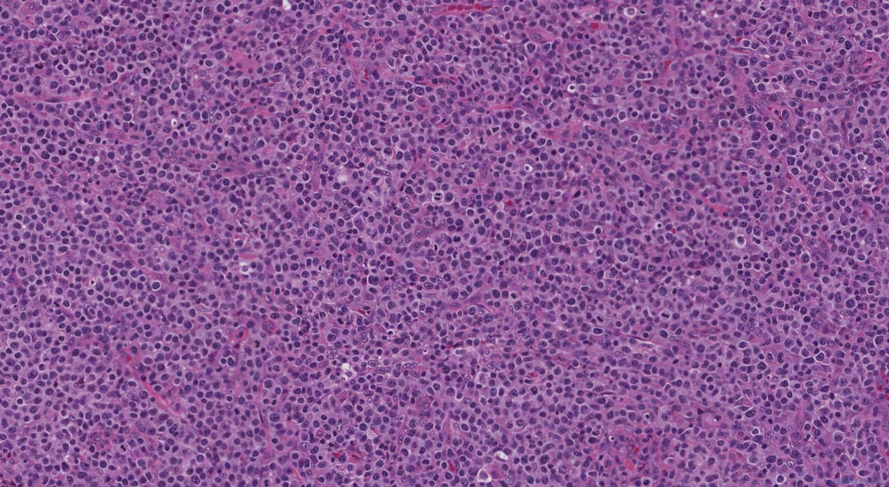 Peripheral T Cell Lymphoma Atlas Of Pathology