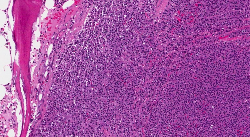 Plasma cell myeloma in a patient with multiple myeloma
