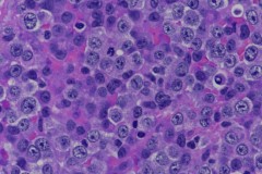 Plasmablastic lymphoma